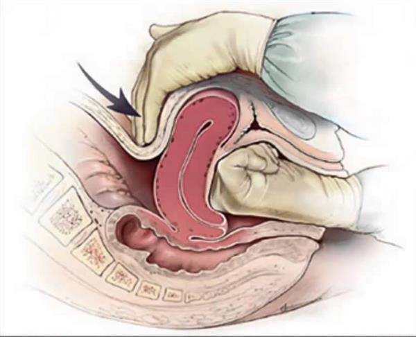 Đờ tử cung là nguyên nhân phổ biến nhất gây ra tình trạng sót rau sau sinh.
